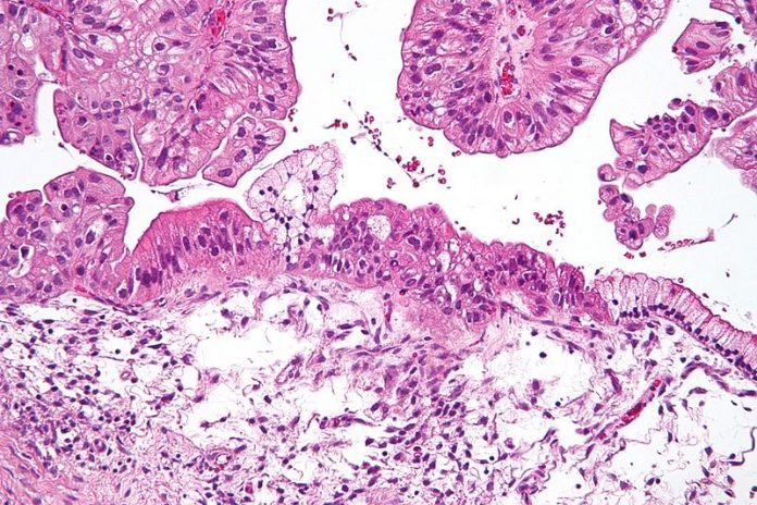 CancerOvario