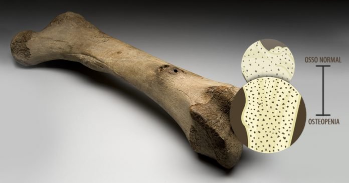 20190127_osteopenia