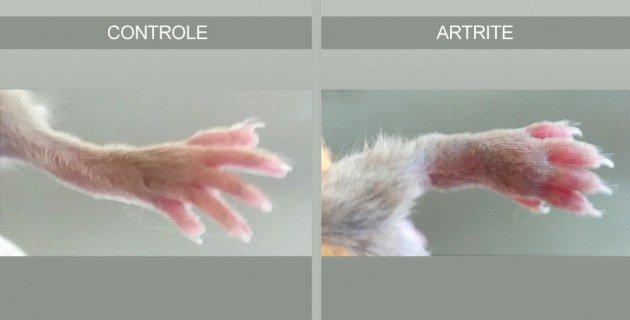 Artrite