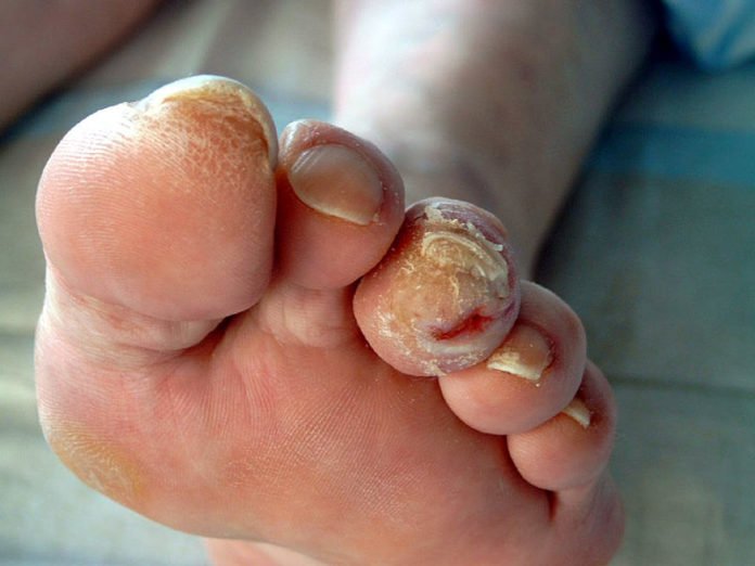 Diabete